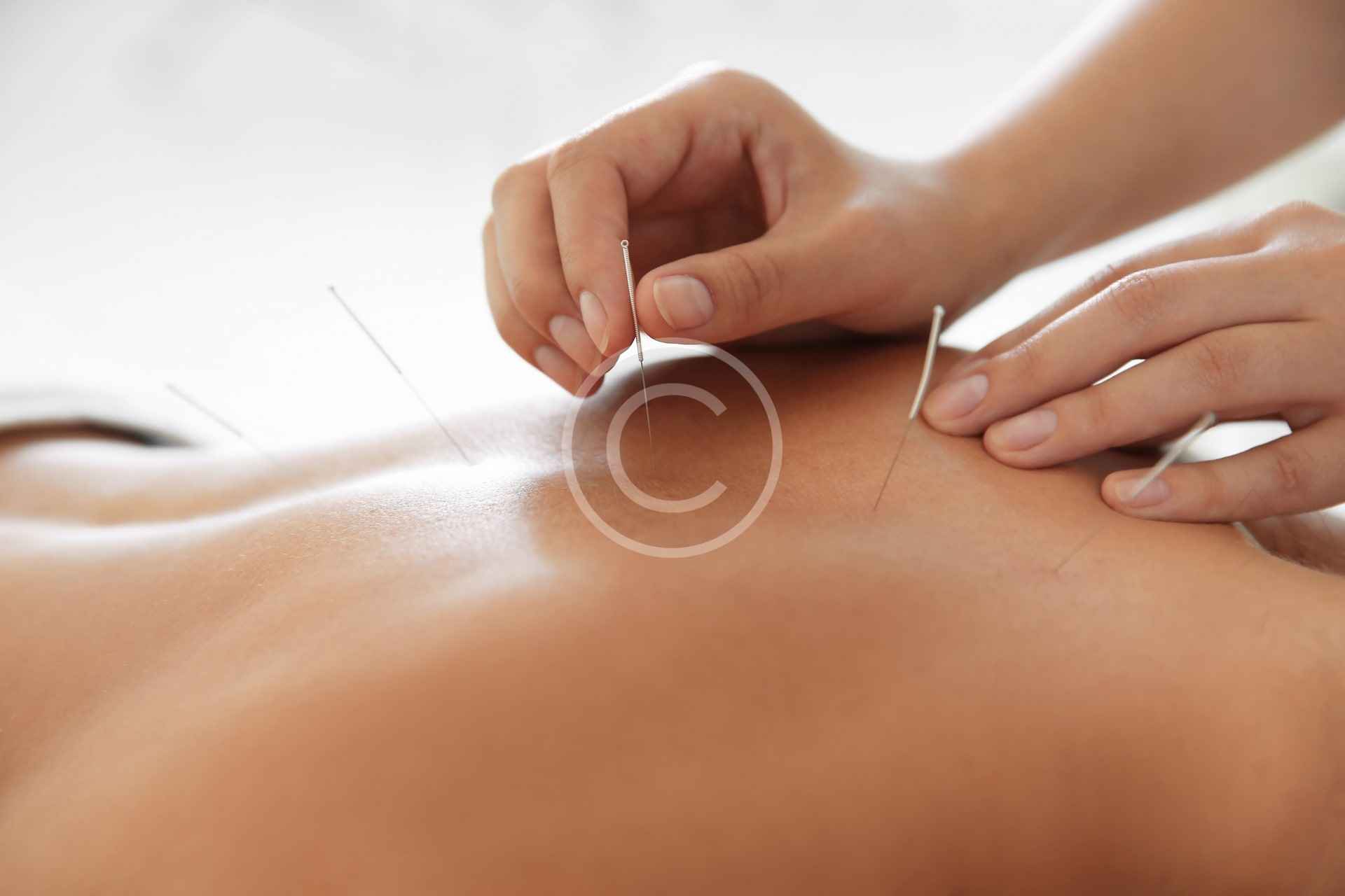 Acupuncture